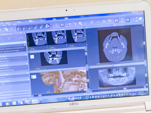 当院のインプラントシステム